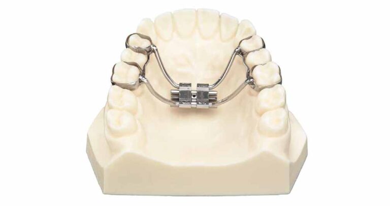 Rapid Maxillary Expansion Treatment| 7 Essential Facts