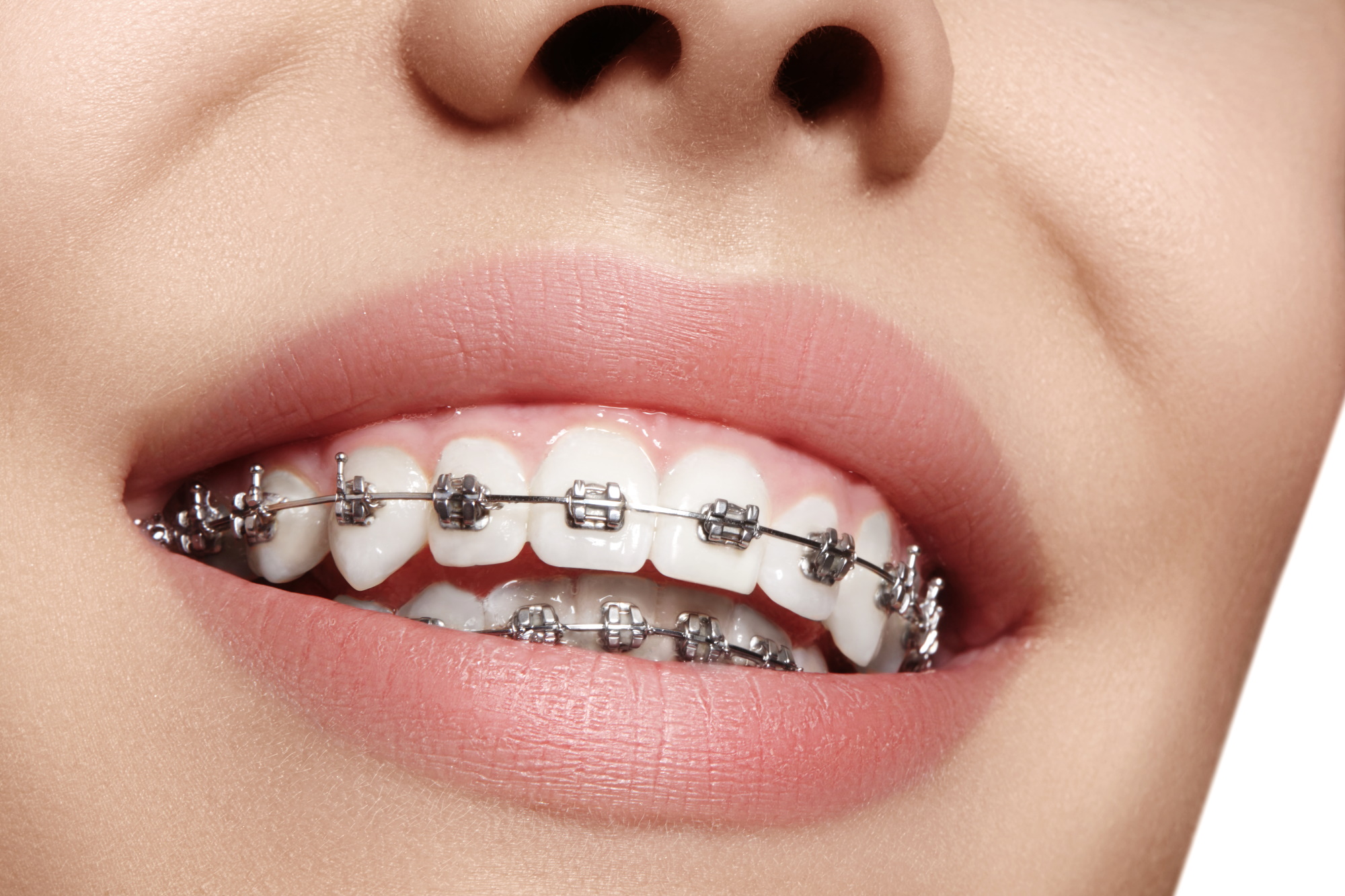 What to do when your braces wire breaks