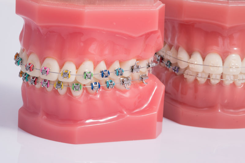 Multicolored Braces